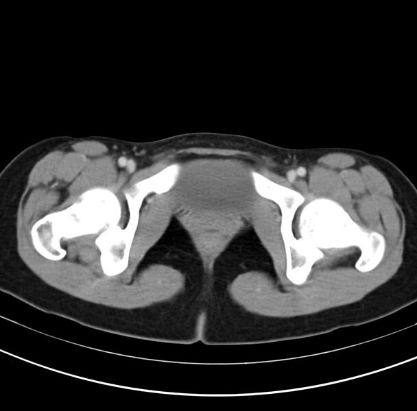 File:Appendicitis and incidental bicornuate uterus (Radiopaedia 22833-22853 B 46).jpg