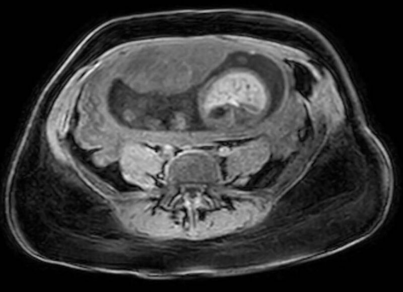 File:Appendicitis in gravida (MRI) (Radiopaedia 89433-106395 Axial DIXON 95).jpg
