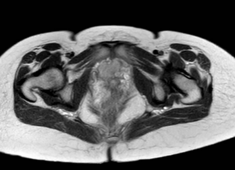 File:Appendicitis in gravida (MRI) (Radiopaedia 89433-106395 Axial T2 69).jpg