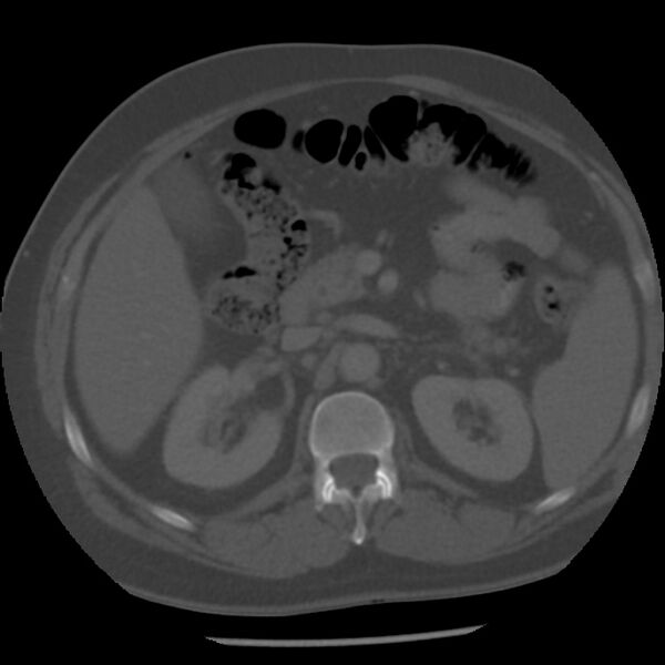 File:Appendicitis with perforation (Radiopaedia 35790-37342 Axial bone window 18).jpg