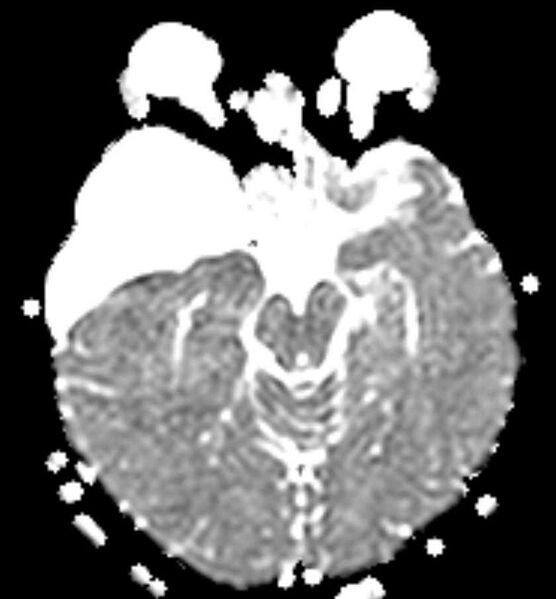 File:Arachnoid cyst- extremely large (Radiopaedia 68741-78451 Axial ADC 10).jpg