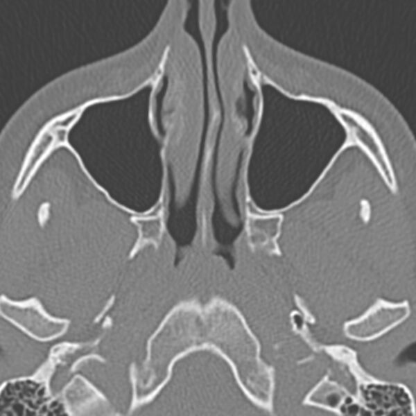 File:Arrested pneumatization of the sphenoid (Radiopaedia 10700-11172 Axial non-contrast 12).jpg
