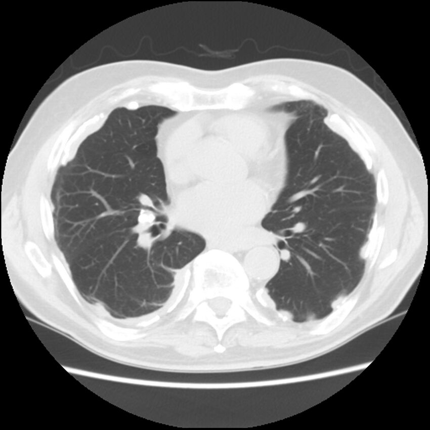 Asbestos-related pleural plaques (Radiopaedia 39069-41255 Axial lung window 42).jpg