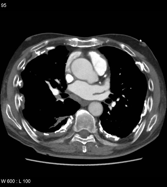 File:Asbestos related lung and pleural disease (Radiopaedia 14377-14301 D 31).jpg