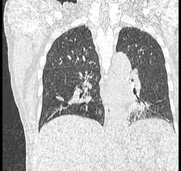 File:Aspergilloma (Radiopaedia 44592-48327 Coronal lung window 81).jpg