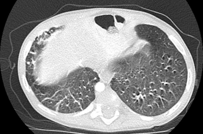 File:Asplenia syndrome (Radiopaedia 73083-83792 Axial lung window 61).jpg