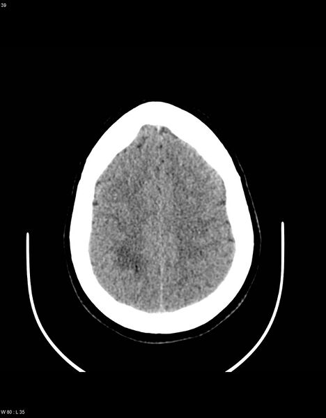 File:Astroblastoma (Radiopaedia 39792-42216 Axial non-contrast 38).jpg