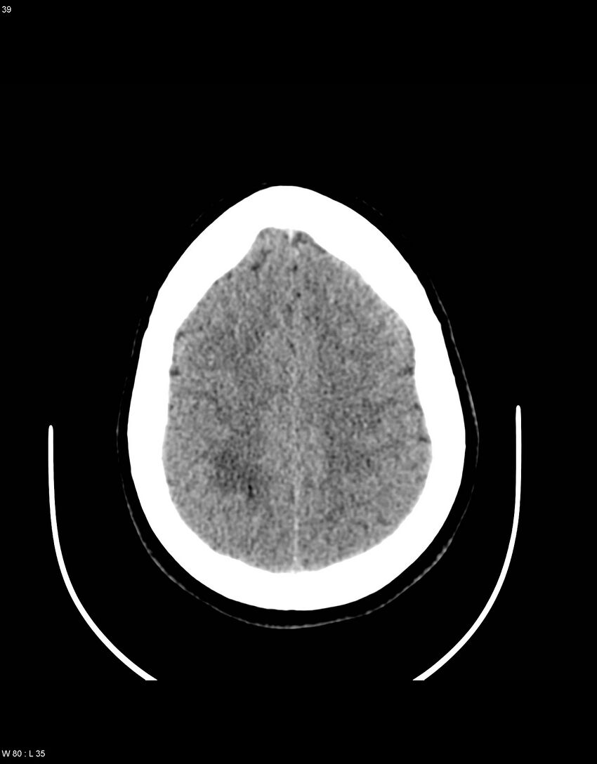 Astroblastoma (Radiopaedia 39792-42216 Axial non-contrast 38).jpg