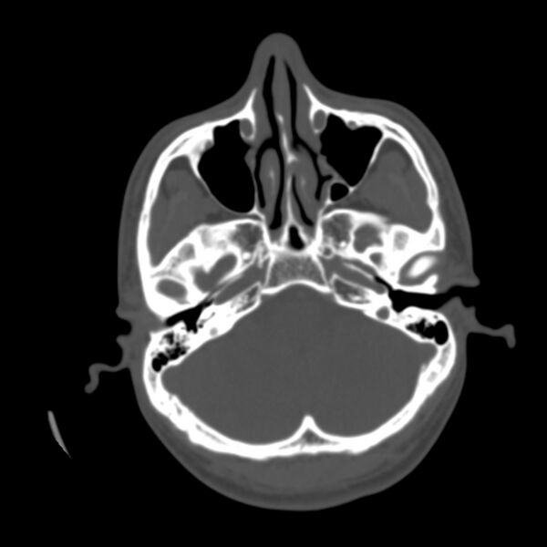 File:Asymptomatic occipital spur (Radiopaedia 87753-104201 Axial bone window 30).jpg