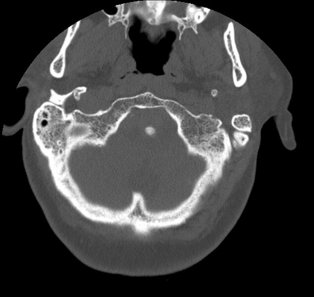 File:Atlanto-occipital assimilation with basilar invagination (Radiopaedia 70122-80188 Axial bone window 9).jpg