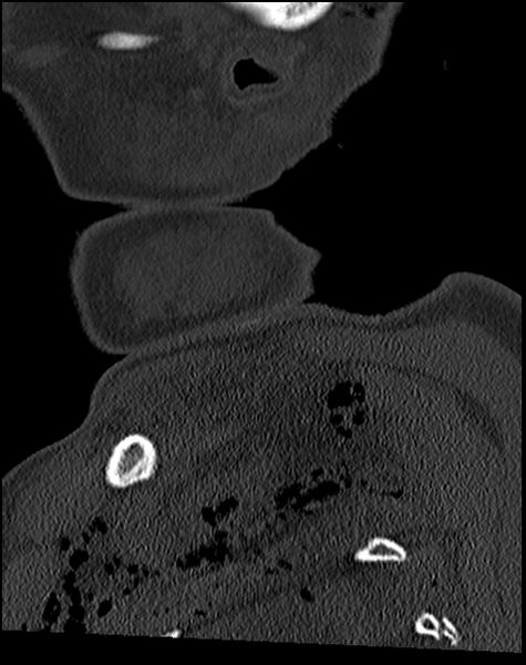 File:Atlanto-occipital dissociation - Traynelis type 1 (Radiopaedia 87570-103948 Sagittal bone window 11).jpg