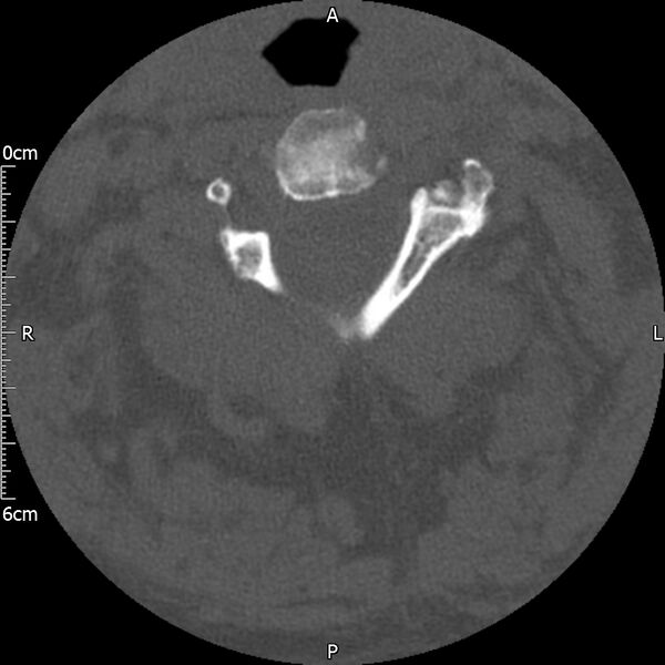 File:Atlas fracture with Currarino type A congenital defect (Radiopaedia 71747-82144 Axial bone window 66).jpg