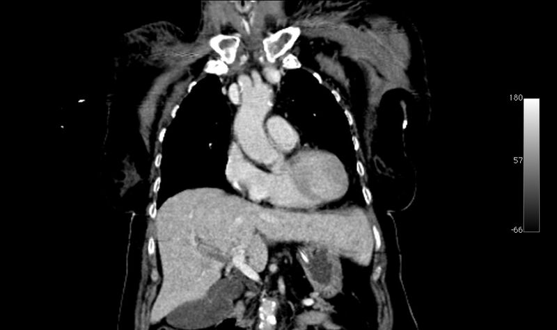 File:Atypical dissection of the thoracic aorta (Radiopaedia 10975-78320 B 6).jpg