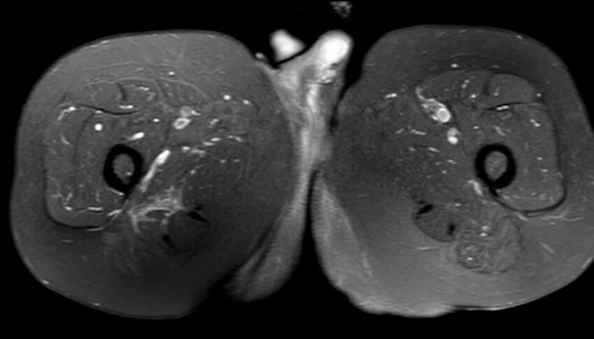 Atypical lipomatous tumor - thigh (Radiopaedia 68975-78734 Axial PD fat sat 68).jpg