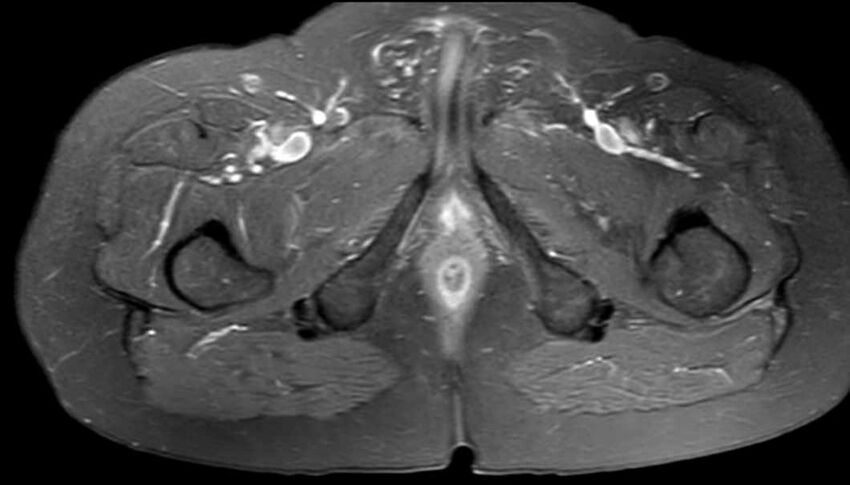 Atypical lipomatous tumor - thigh (Radiopaedia 68975-78734 Axial PD fat sat 83).jpg
