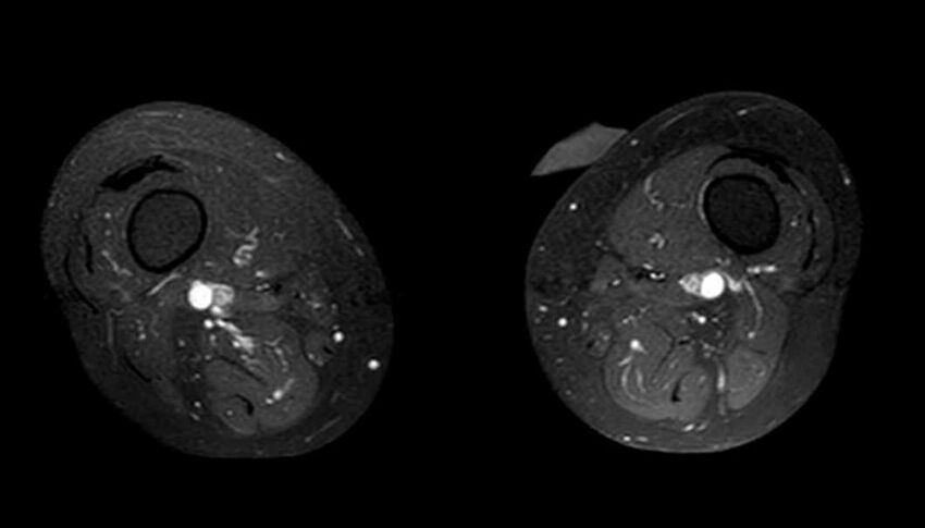 Atypical lipomatous tumor - thigh (Radiopaedia 68975-78734 Axial T1 C+ fat sat 29).jpg