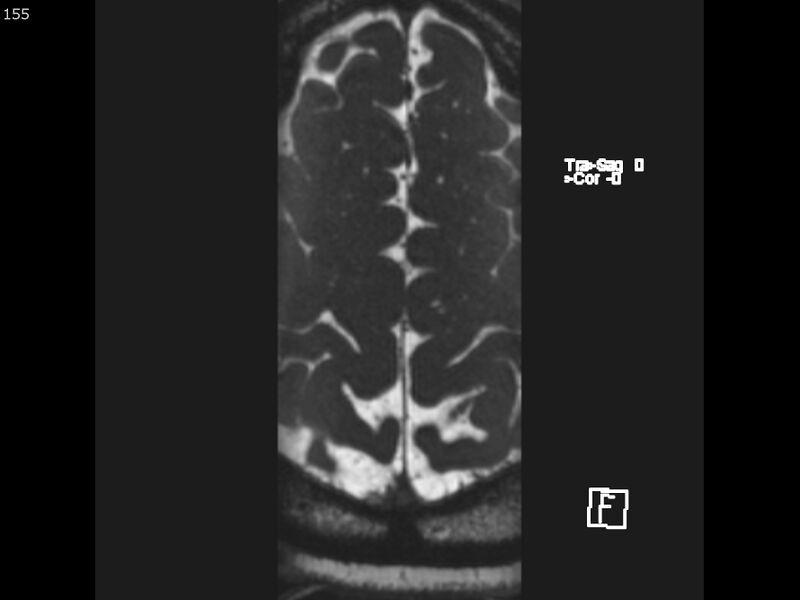 File:Atypical meningioma - intraosseous (Radiopaedia 64915-74572 Axial CISS 155).jpg