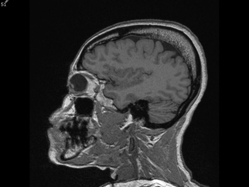 Atypical meningioma - intraosseous (Radiopaedia 64915-74572 Sagittal T1 51).jpg