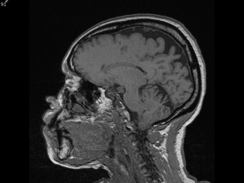File:Atypical meningioma - intraosseous (Radiopaedia 64915-74572 Sagittal T1 91).jpg