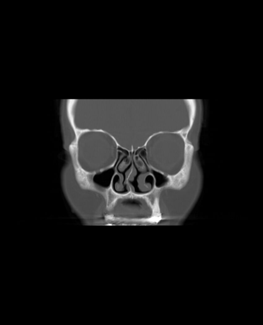 Automastoidectomy with labyrinthine fistula (Radiopaedia 84143-99411 Coronal non-contrast 22).jpg