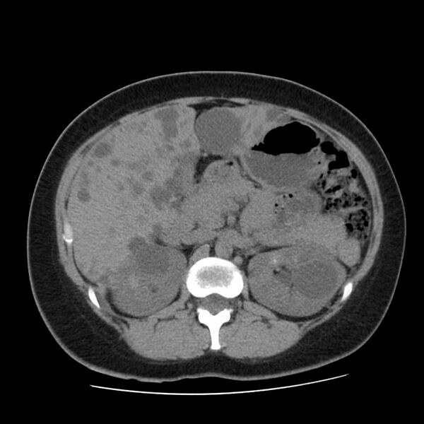 File:Autosomal dominant polycystic kidney disease (Radiopaedia 23061-23093 Axial non-contrast 22).jpg