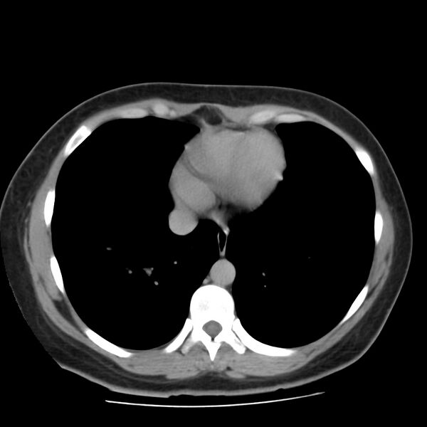 File:Autosomal dominant polycystic kidney disease (Radiopaedia 23061-23093 C+ delayed 2).jpg