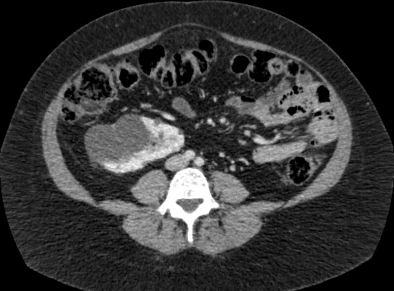 File:Autosomal dominant polycystic kidney disease (Radiopaedia 57124-64017 A 68).jpg