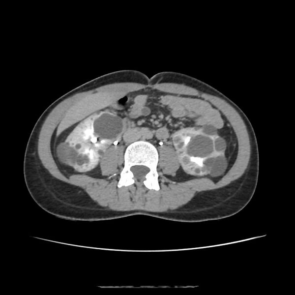 File:Autosomal dominant polycystic kidney disease - early onset (Radiopaedia 40734-43387 D 11).jpg