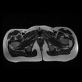 Avascular necrosis of the hip (Radiopaedia 29563-30067 Axial T2 14).jpg