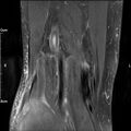 Avulsion fracture of the fibular head (Radiopaedia 74804-85808 Coronal PD fat sat 31).jpg