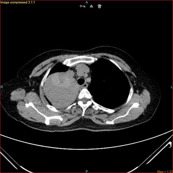File:Azygos vein aneurysm (Radiopaedia 77824-90130 A 15).jpg