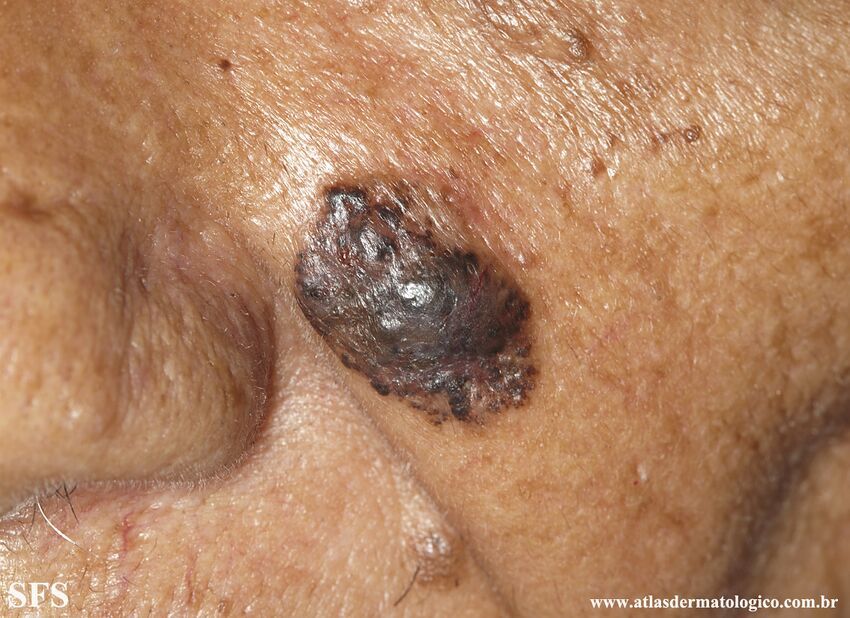 Basal Cell Carcinoma (Dermatology Atlas 299).jpg