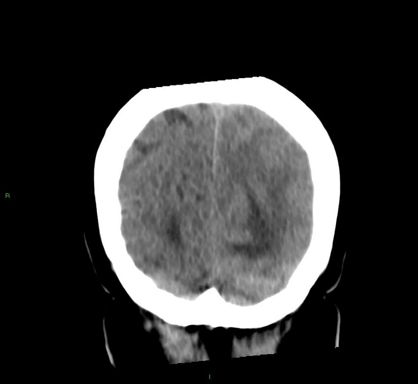 Basal ganglia hemorrhage (Radiopaedia 58759-65981 Coronal non-contrast 18).jpg