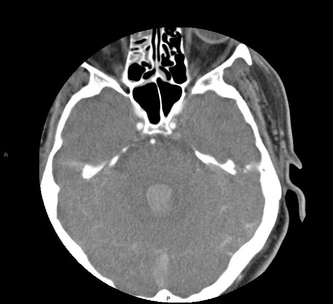 File:Basal ganglia hemorrhage (Radiopaedia 58763-65985 D 60).jpg