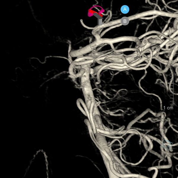 File:Basilar artery perforator aneurysm (Radiopaedia 82455-97734 3D view left VA 13).jpg