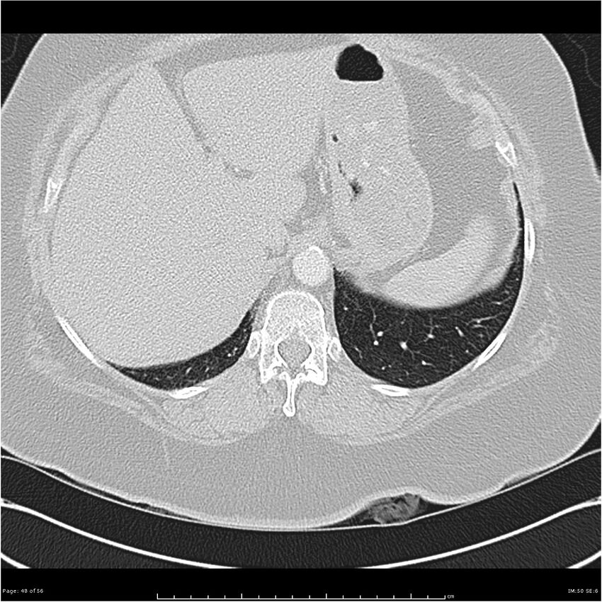 Benign metastasizing leiomyoma (Radiopaedia 26803-26962 Axial lung window 48).jpg