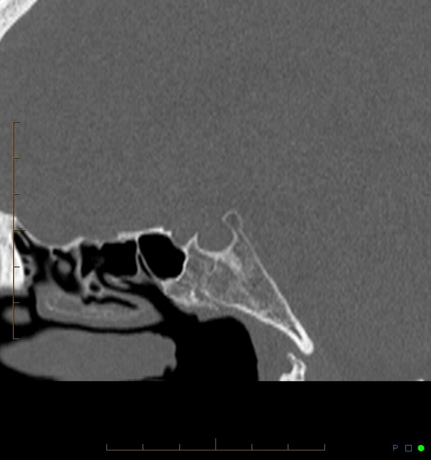 Benign notochordal cell tumor (probable) (Radiopaedia 65475-74546 Sagittal bone window 30).jpg