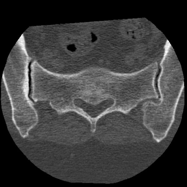 File:Bertolotti syndrome (Radiopaedia 24864-25128 Axial bone window 46).jpg