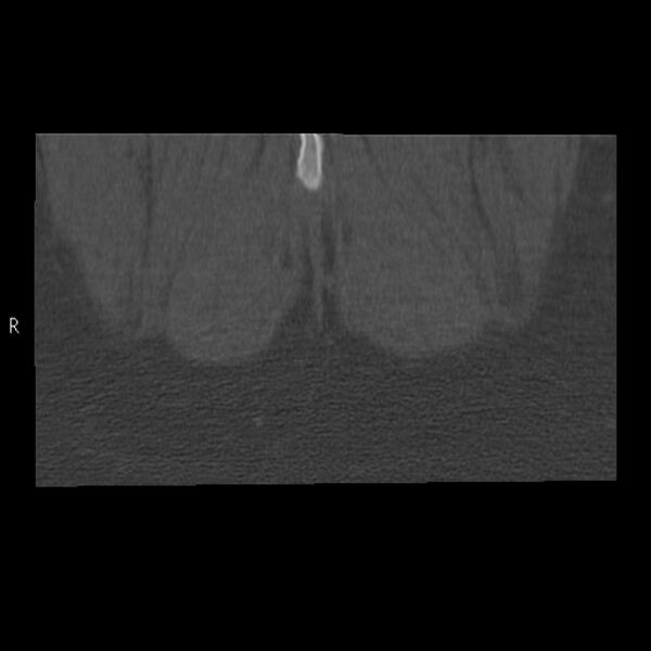 File:Bertolotti syndrome (Radiopaedia 24864-25128 Coronal bone window 59).jpg