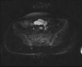 Bicornuate bicollis uterus (Radiopaedia 61626-69616 Axial PD fat sat 7).jpg