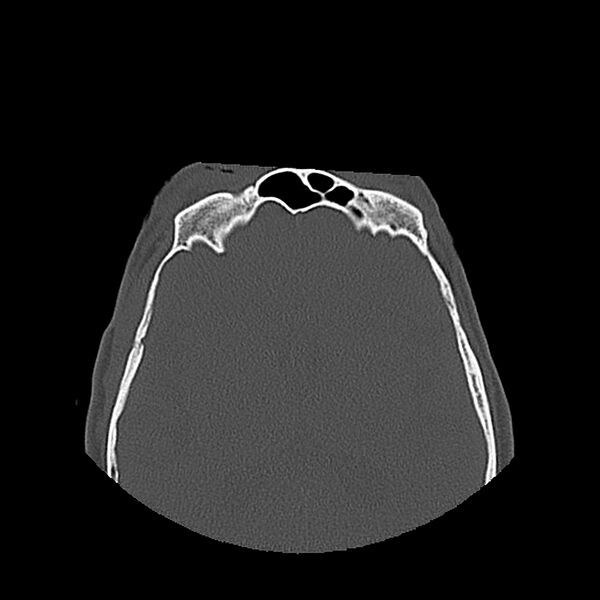 File:Bilateral Le Fort fractures (Radiopaedia 32192-33135 Axial bone window 77).jpg