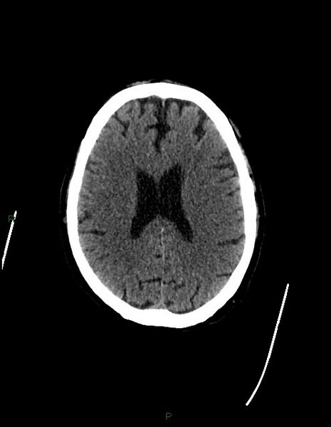 File:Bilateral acute middle cerebral artery territory infarcts (Radiopaedia 77319-89401 Axial non-contrast 56).jpg