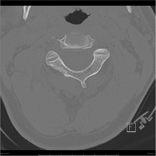 File:Bilateral cervical ribs (Radiopaedia 25868-26017 Axial bone window 17).jpg