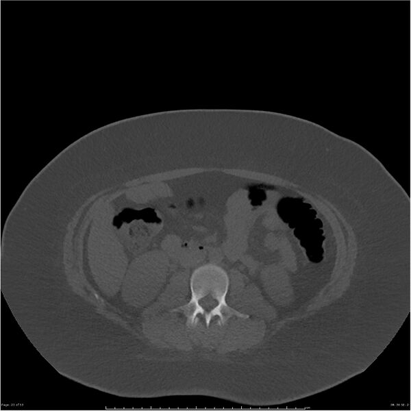 File:Bilateral lumbar ribs (Radiopaedia 25862-26010 bone window 21).jpg