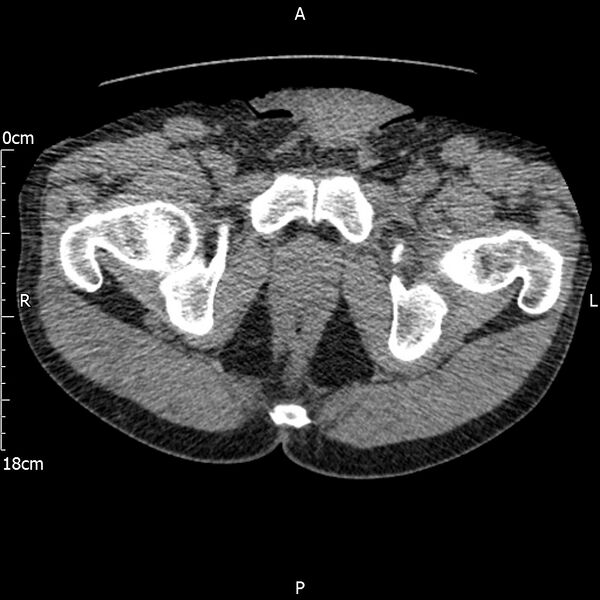File:Bilateral medullary nephrocalcinosis with ureteric calculi (Radiopaedia 71269-81569 Axial non-contrast 134).jpg