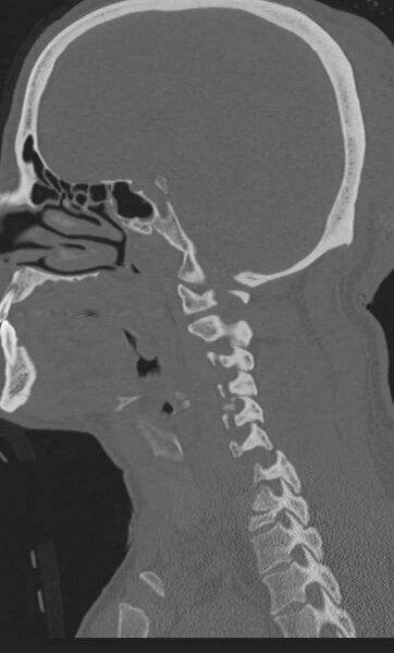 File:Bilateral perched facet joint (Radiopaedia 63149-71669 Sagittal bone window 12).jpg