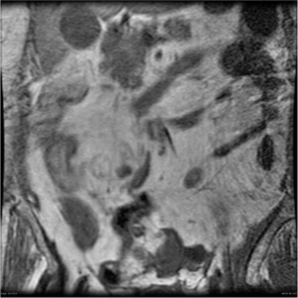 File:Bilateral psoas hematomas (Radiopaedia 24057-24280 B 20).jpg