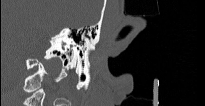 File:Bilateral temporal bone fractures (Radiopaedia 29482-29970 B 49).jpg