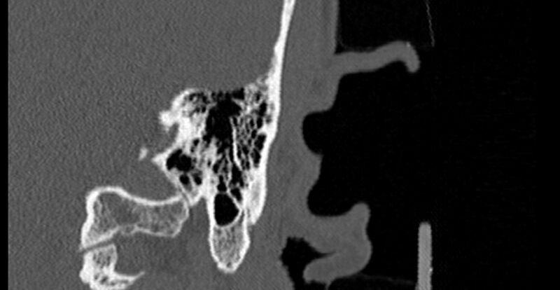 File:Bilateral temporal bone fractures (Radiopaedia 29482-29970 B 73).jpg