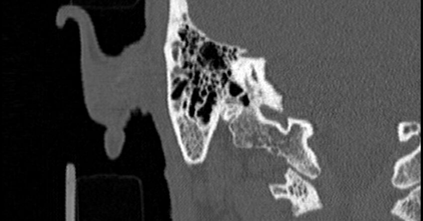 Bilateral temporal bone fractures (Radiopaedia 29482-29970 Coronal non-contrast 146).jpg